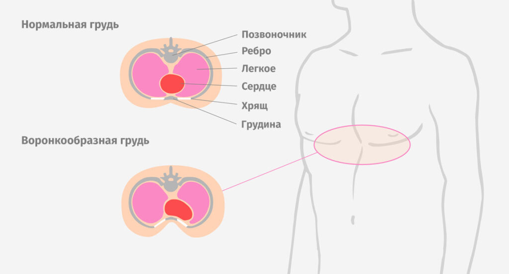 Воронкообразная грудь
