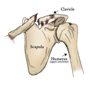 severe clavicle injury