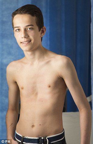 Patient with pigeon chest after 1-yr using of pectus carinatum brace