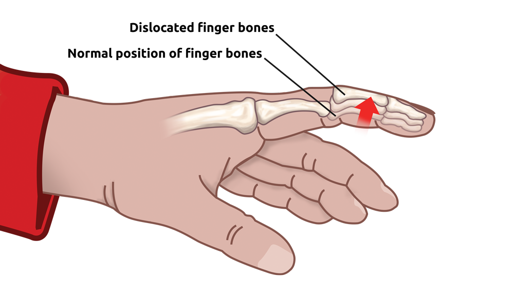 dislocated finger