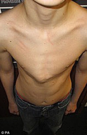 Patient with pigeon chest before treatment